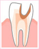 C3 神経の虫歯