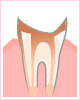 C4 歯根の虫歯