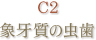 C2 象牙質の虫歯