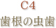 C4 歯根の虫歯